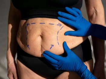 O Custeio de Cirurgia Plástica Reparadora após Bariátrica é Responsabilidade dos Planos de Saúde